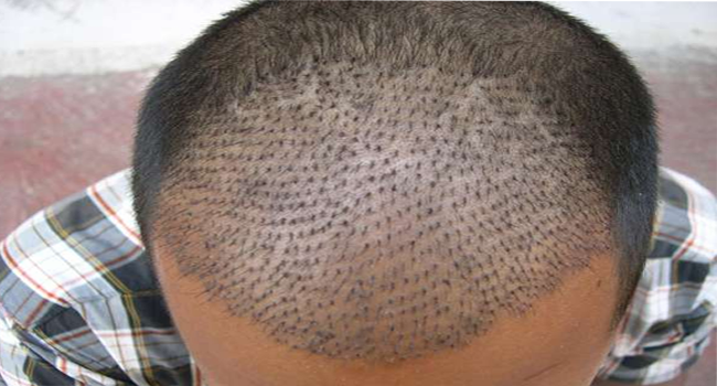 how to regrow hair on bald scalp